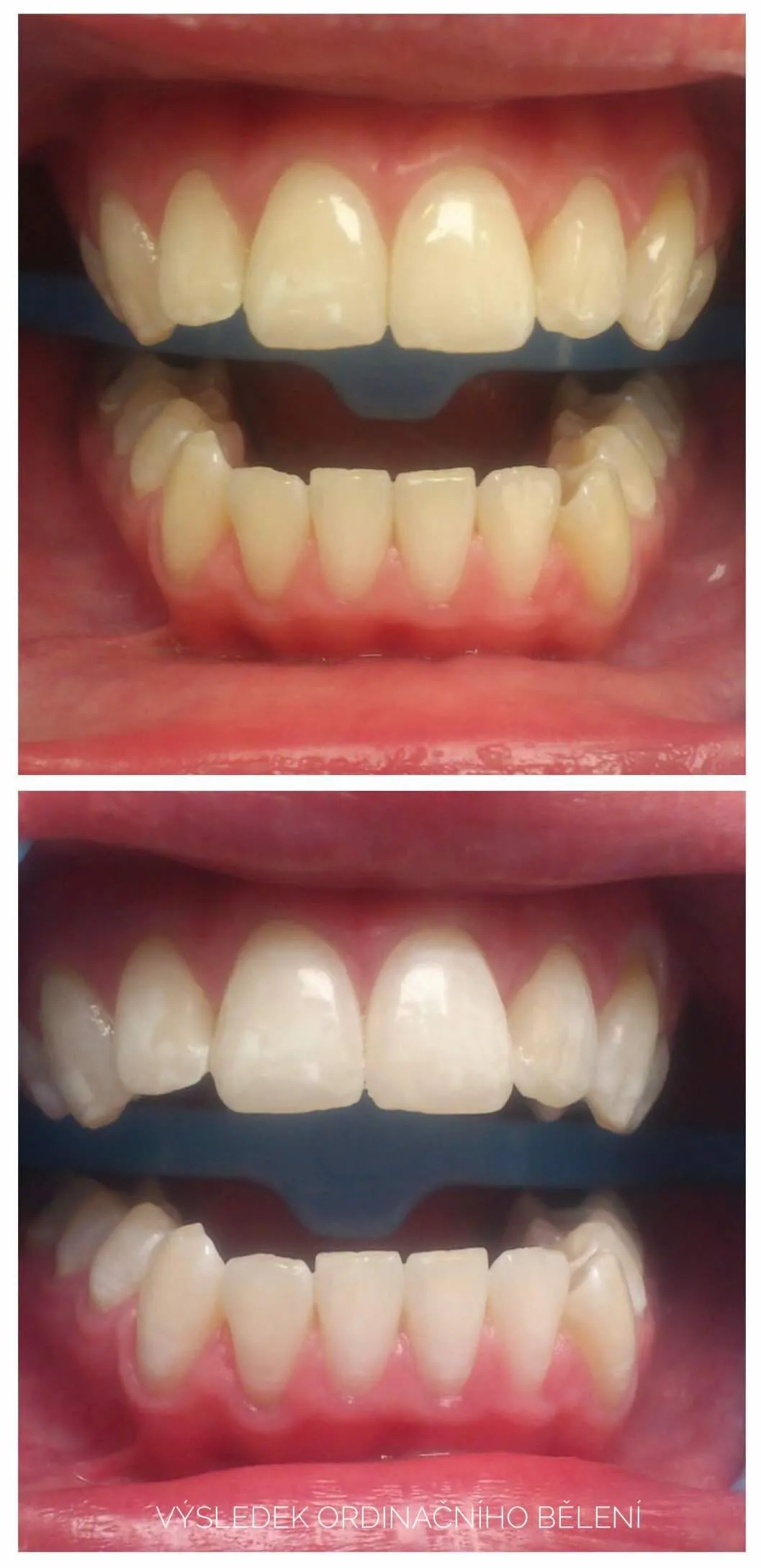 Bělení zubů, před a po 1