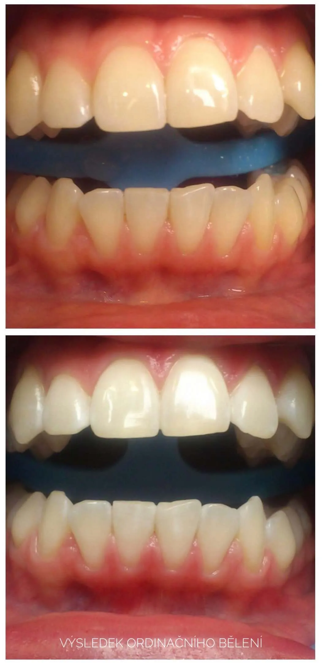 Bělení zubů, před a po 2