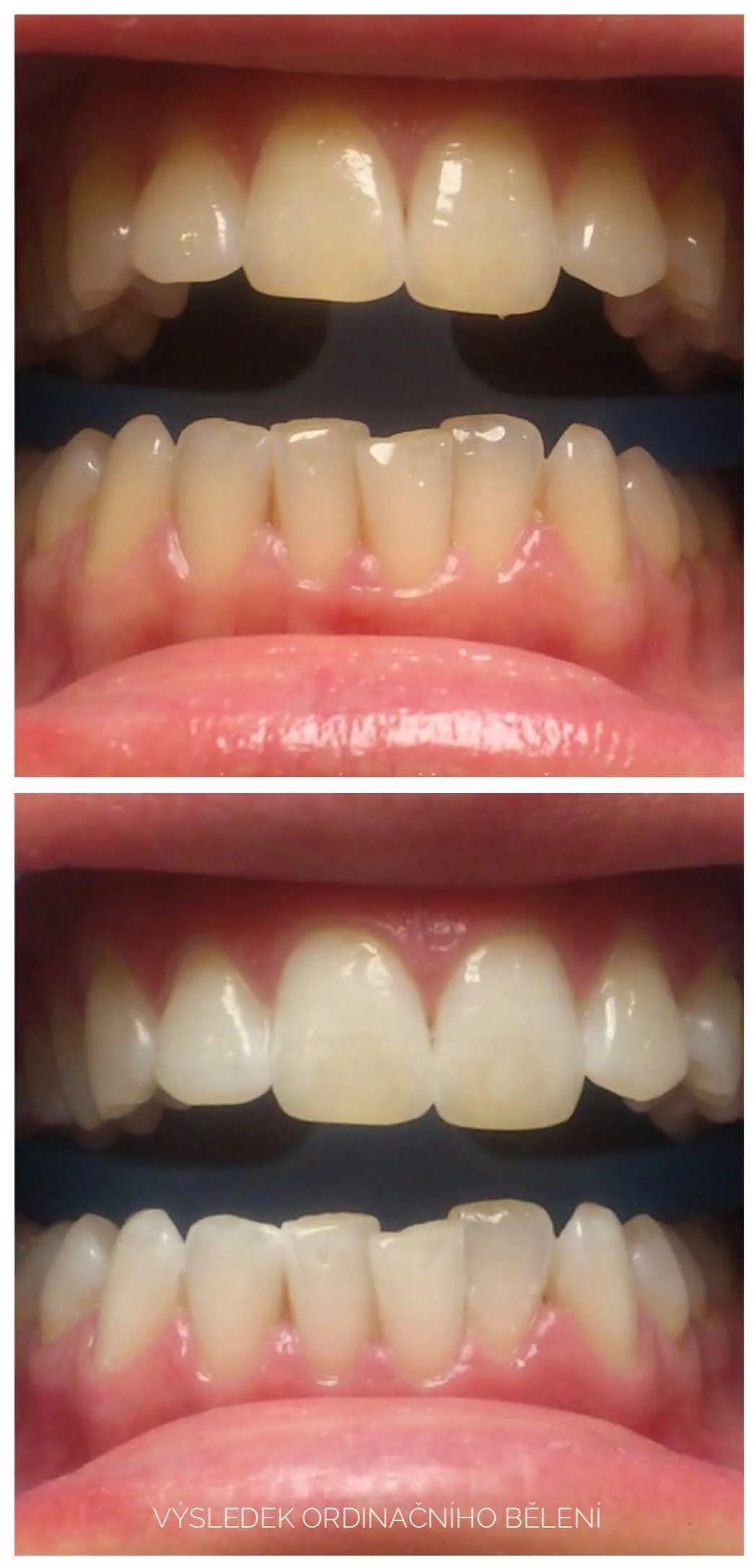 Bělení zubů, před a po 3