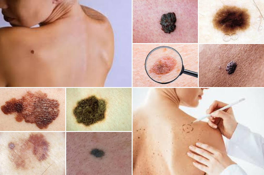 DenMelanomu