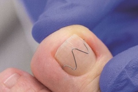 Oboustranná rovnátka na nehty