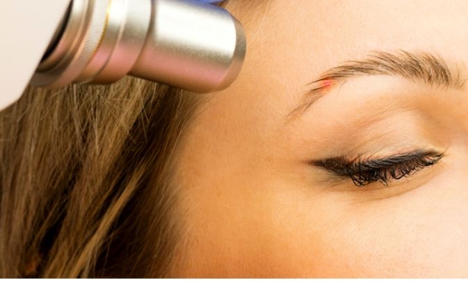 Laserové odstranění permanetního makeupu